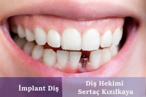 İmplant Diş Fiyatı